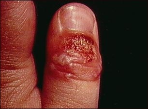 Panadizo herp&eacute;tico del pulgar