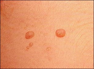 Molusco contagioso-primer plano