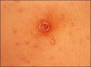 Molusco contagioso- primer plano del t&oacute;rax