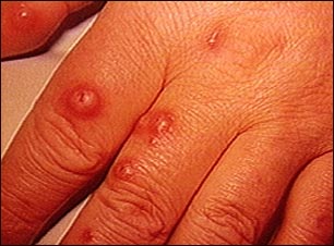 Criptococo cut&aacute;neo en la mano