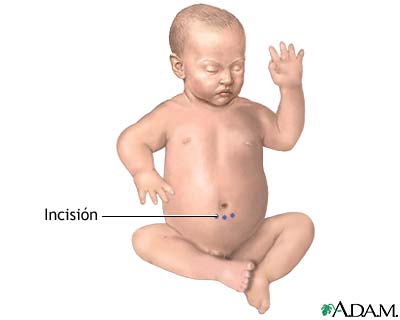 Incisi&oacute;n