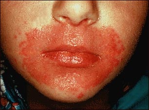 Candidiasis cut&aacute;nea alrededor de la boca