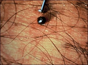 Garrapata llena de sangre en la piel de venado