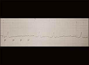 Registro del ECG durante un bloqueo auriculoventricular