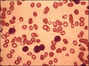 Leucemia linfoc&iacute;tica cr&oacute;nica; vista microsc&oacute;pica