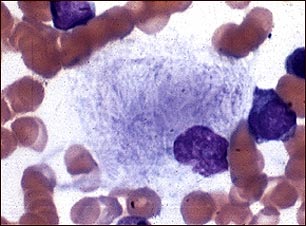 Microfotograf&iacute;a de c&eacute;lula de Gaucher