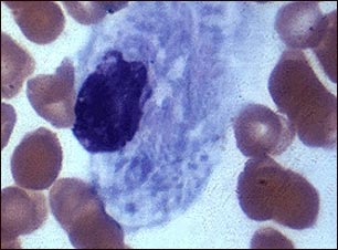 Microfotograf&iacute;a 2 de c&eacute;lula de Gaucher