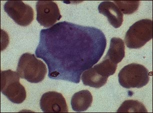 Mononucleosis, microfotograf&iacute;a de c&eacute;lulas