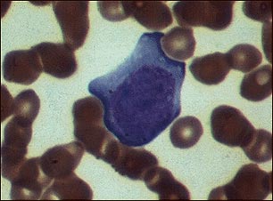 Mononucleosis, microfotograf&iacute;a de c&eacute;lulas