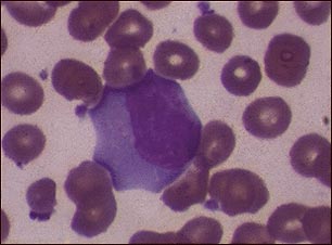 Mononucleosis infecciosa #3