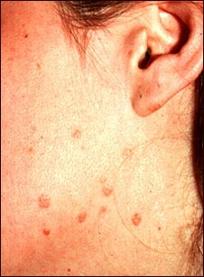 Verrugas planas en la mejilla y el cuello