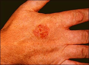 Enfermedad de Bowen de la mano