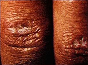 P&aacute;pula de Gottron en dermatomiositis