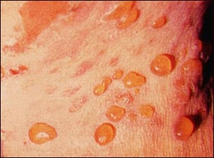 Penfigoide buloso; vista de cerca de ampollas muy llenas