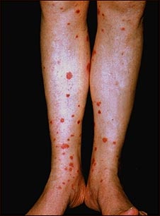 P&uacute;rpura de Henoch-Schonlein en la parte inferior de la piernas