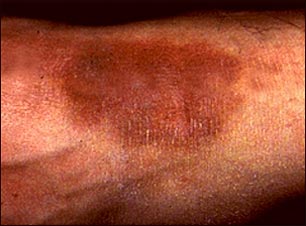 Liquen simple y cr&oacute;nico del tobillo