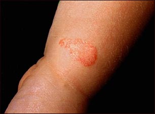 Ti&ntilde;a corporal en la pierna del infante