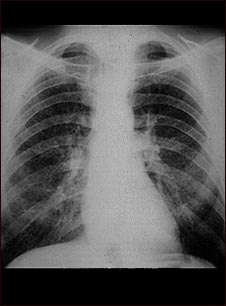 Pulmones de un trabajador del carb&oacute;n; rayos X