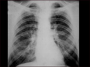 Neumoconiosis del minero en etapa II