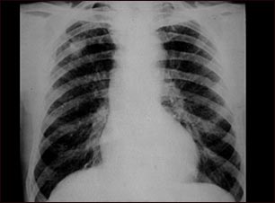 Neumoconiosis del minero, Etapa II #2
