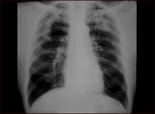 Neumoconiosis complicada del minero