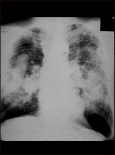 Neumoconiosis en trabajadores del carb&oacute;n; complicada #2