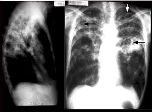 Tuberculosis avanzada, radiograf&iacute;a de t&oacute;rax
