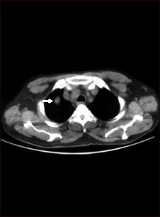 N&oacute;dulo pulmonar solitario; TC