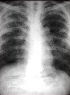 Sarcoidosis, estado II - radiograf&iacute;a de t&oacute;rax