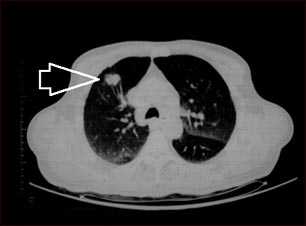 Masa pulmonar, l&oacute;bulo superior derecho - Tomograf&iacute;a computarizada