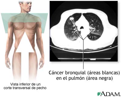 TC de c&aacute;ncer bronquial