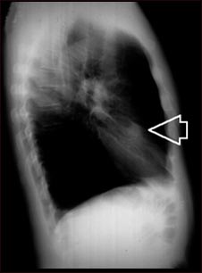 N&oacute;dulo pulmonar, l&oacute;bulo medio derecho- Radiograf&iacute;a de t&oacute;rax