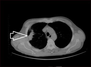 Masa pulmonar, pulm&oacute;n derecho - Tomograf&iacute;a.