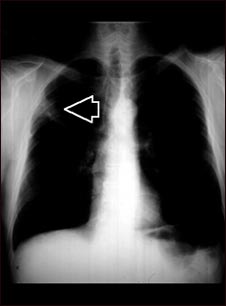 Masa pulmonar, pulm&oacute;n superior derecho - Radiograf&iacute;a de t&oacute;rax