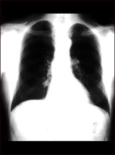 N&oacute;dulo pulmonar - Vista frontal de la radiograf&iacute;a de t&oacute;rax