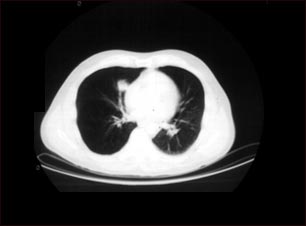N&oacute;dulo pulmonar, pulm&oacute;n inferior derecho - Tomograf&iacute;a computarizada