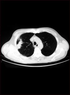 Pulm&oacute;n con c&aacute;ncer de c&eacute;lulas escamosas - Tomograf&iacute;a computarizada