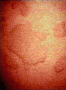 Urticaria - vista de cerca