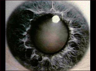 Catarata: primer plano del ojo