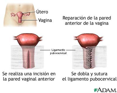 Reparaci&oacute;n de la pared vaginal anterior
