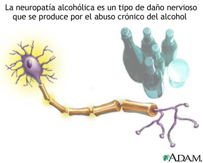 Neuropat&iacute;a alcoh&oacute;lica