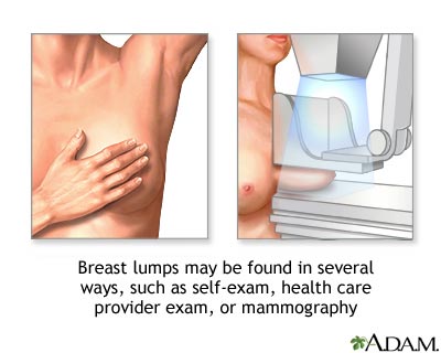 Protuberancias mamarias