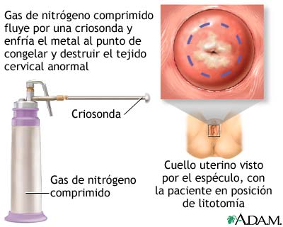 Criocirug&iacute;a cervical