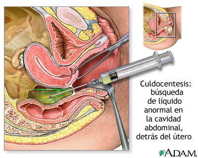 Culdocentesis