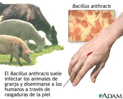 &Aacute;ntrax cut&aacute;neo