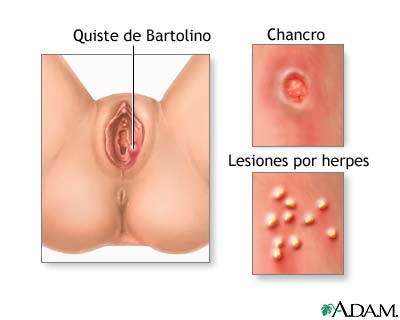Llagas genitales (en mujeres)