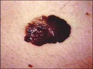 C&aacute;ncer de piel o melanoma: lesi&oacute;n oscura saliente