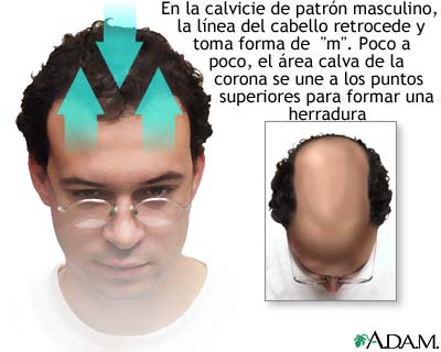 Calvicie de patr&oacute;n masculino