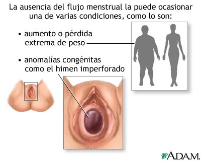 Ausencia de la menstruaci&oacute;n (amenorrea)