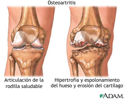 Osteoartritis